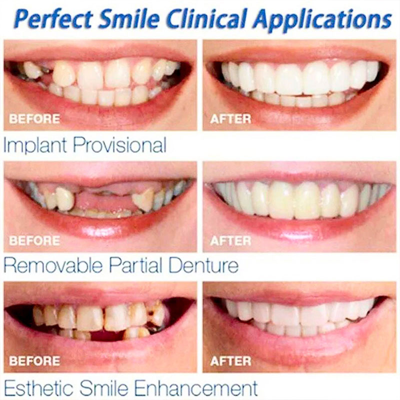 Cosmetic Teeth Veneers Comfort Fit Flex Dental Care TOP ...