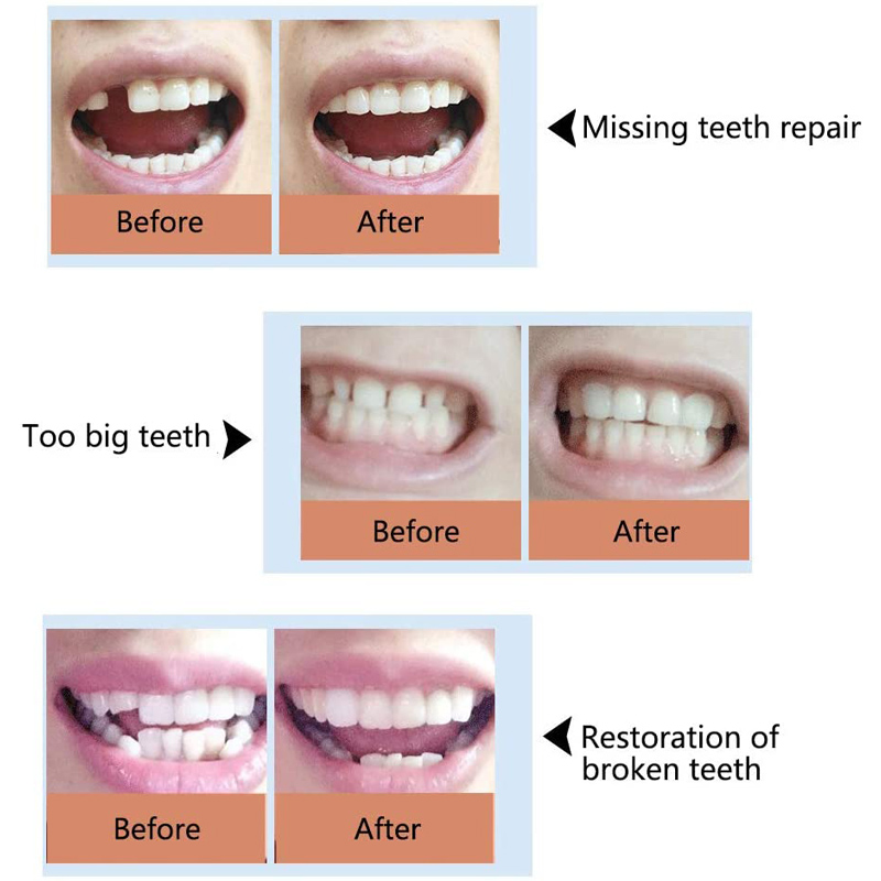 100g Adhesive Beads Fix Broken Teeth Temporary Tooth Repair Kit